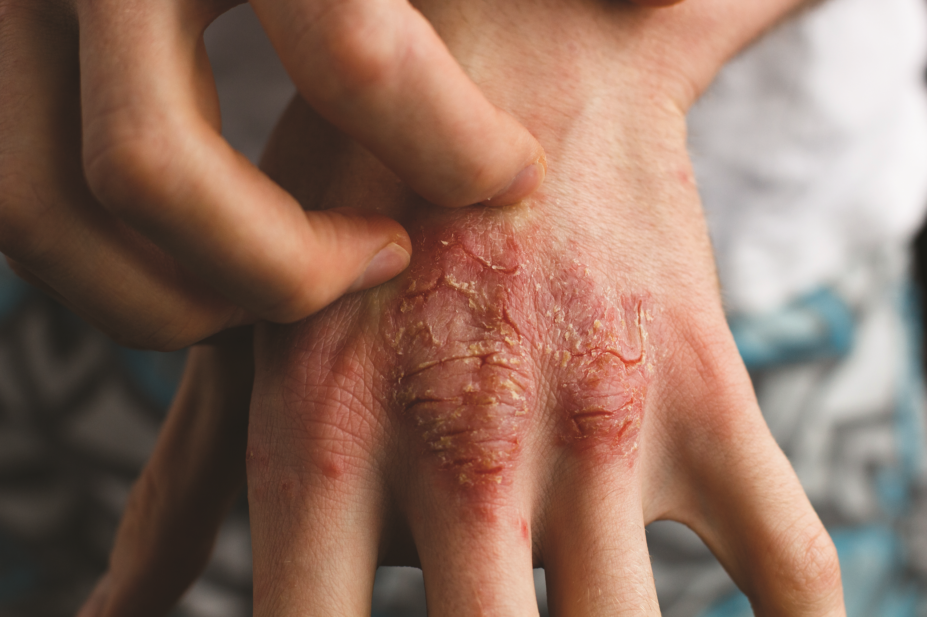 moderate to severe psoriasis