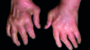 Hands with psoriatic arthritis