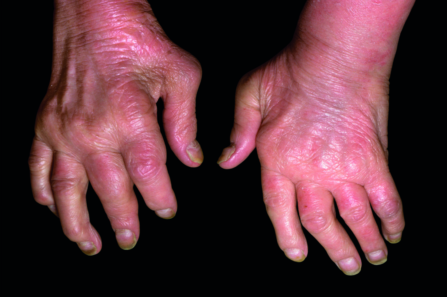 Biologic medicine effective against refractory psoriatic arthritis ...