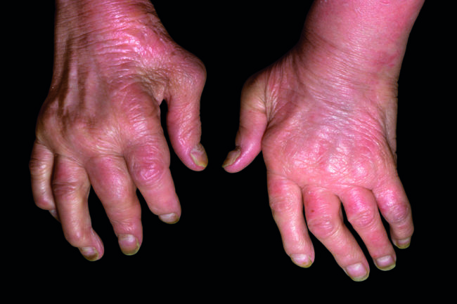 Biologic medicine effective against refractory psoriatic arthritis ...