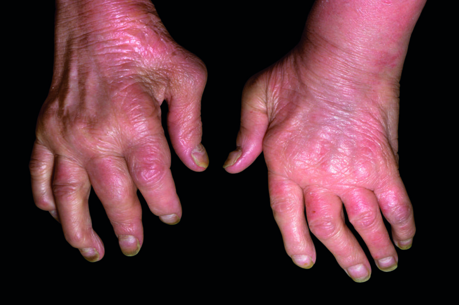 Hands with psoriatic arthritis