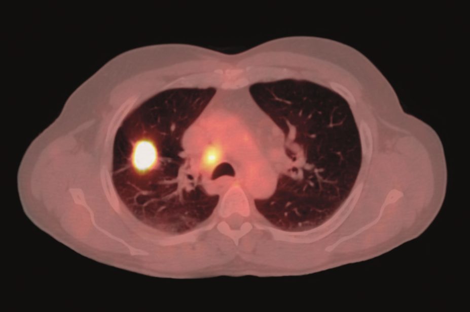 Osimertinib, a new treatment for locally advanced or metastatic non small-cell lung cancer (NSCLC), is being made available to patients under the UK government’s Early Assess to Medicines Scheme. In the image, PT scan of a patient showing NSCLC