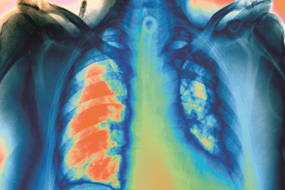Patients recovering from their first pulmonary embolism who received an extra 18-months of anticoagulant (warfarin) treatment lost the benefit of that treatment once their treatment came to an end. In the image, x-ray of a pulmonary embolism