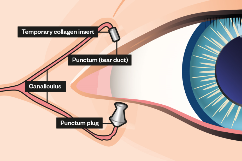 punctal plug eye anatomy pj 17