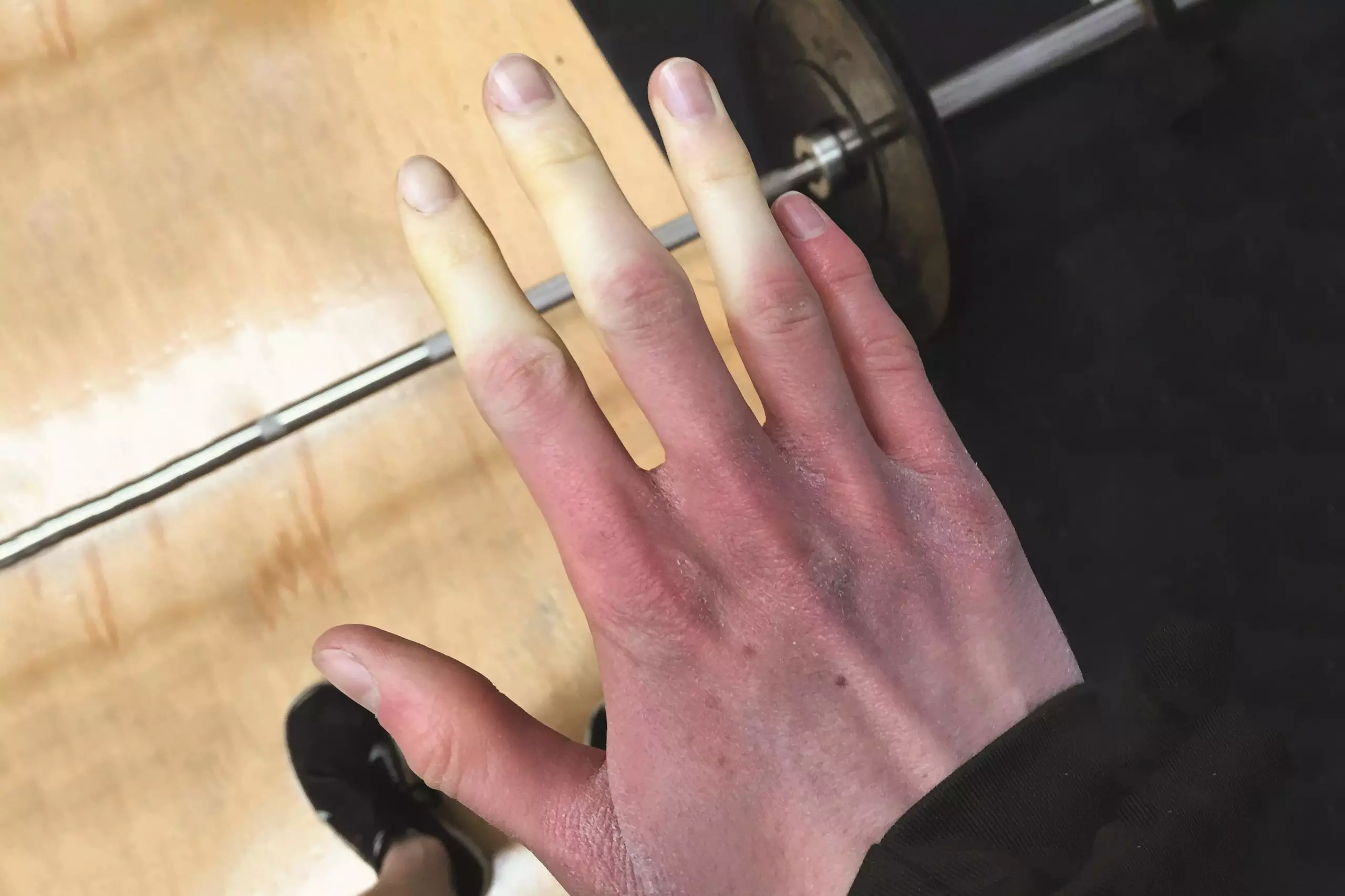 Drug induced Raynaud s phenomenon probably underestimated The