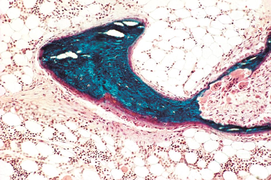 Chronic Kidney Disease - Mineral and Bone Disorder (CKD-MBD) is used to describe the pathophysiological changes that occur in the vascular and skeletal system in CKD and was previous called renal bone disease (light micrograph pictured)