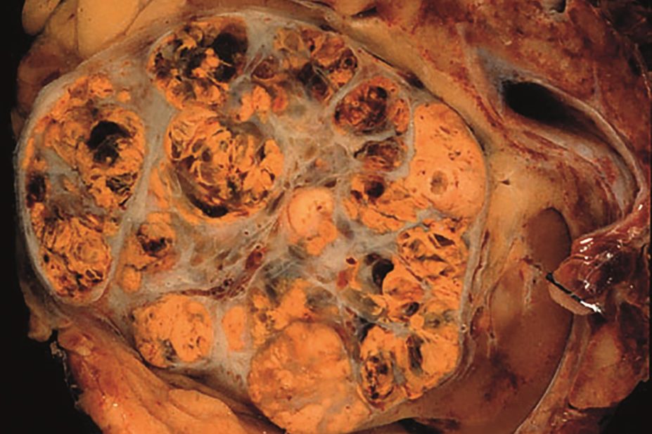 Micrograph of renal cell carcinoma
