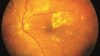 Wider use of ranibizumab could help prevent sight loss in thousands of US adults with diabetic macular oedema. In the image, retina damage from diabetes