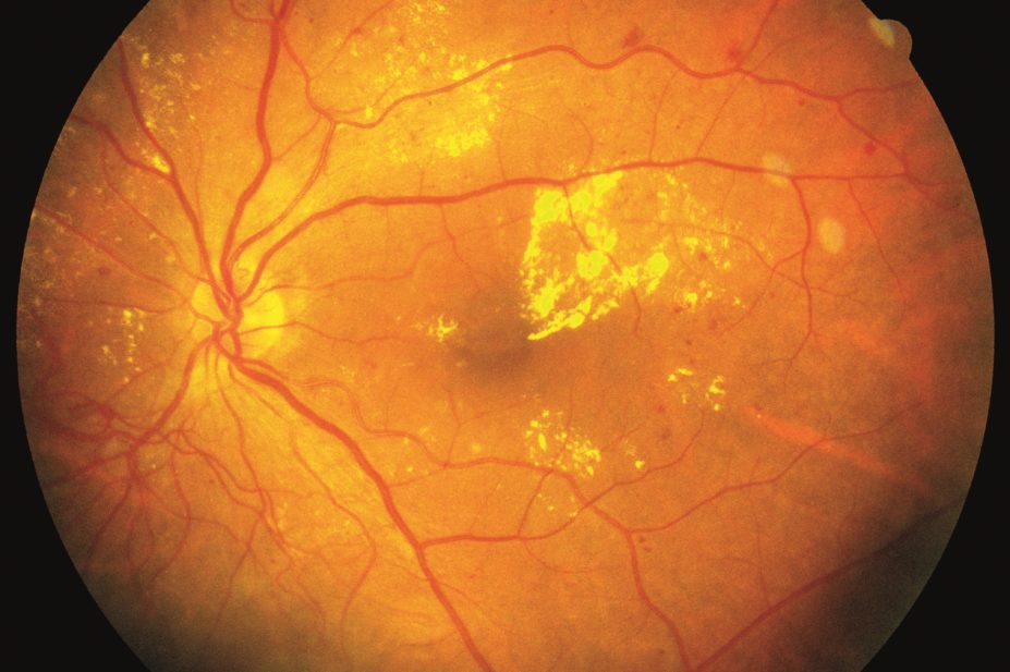 Wider use of ranibizumab could help prevent sight loss in thousands of US adults with diabetic macular oedema. In the image, retina damage from diabetes