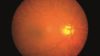 Retinal image of the eye of a woman with glaucoma