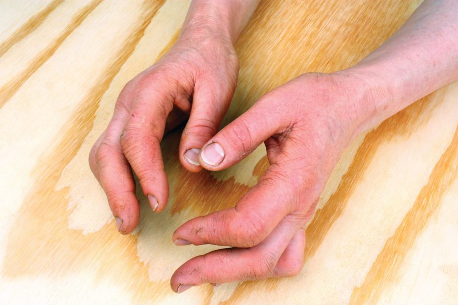 woman with rheumatoid arthritis in hands