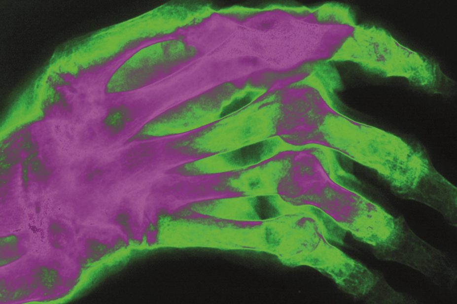 Evidence to support intensive treatment with disease-modifying anti-rheumatic drugs (DMARDs) when patients are first diagnosed with rheumatoid arthritis. In the image, x-ray of a patient's hand with rheumatoid arthritis
