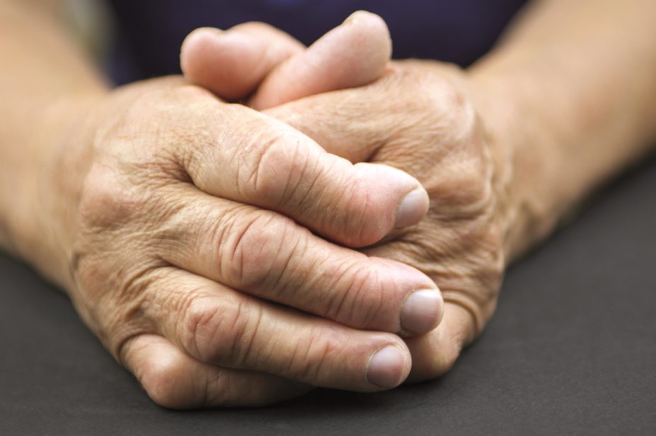 Hands showing symptoms of rheumatoid arthritis