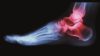 X-ray of rheumatoid arthritis in ankle