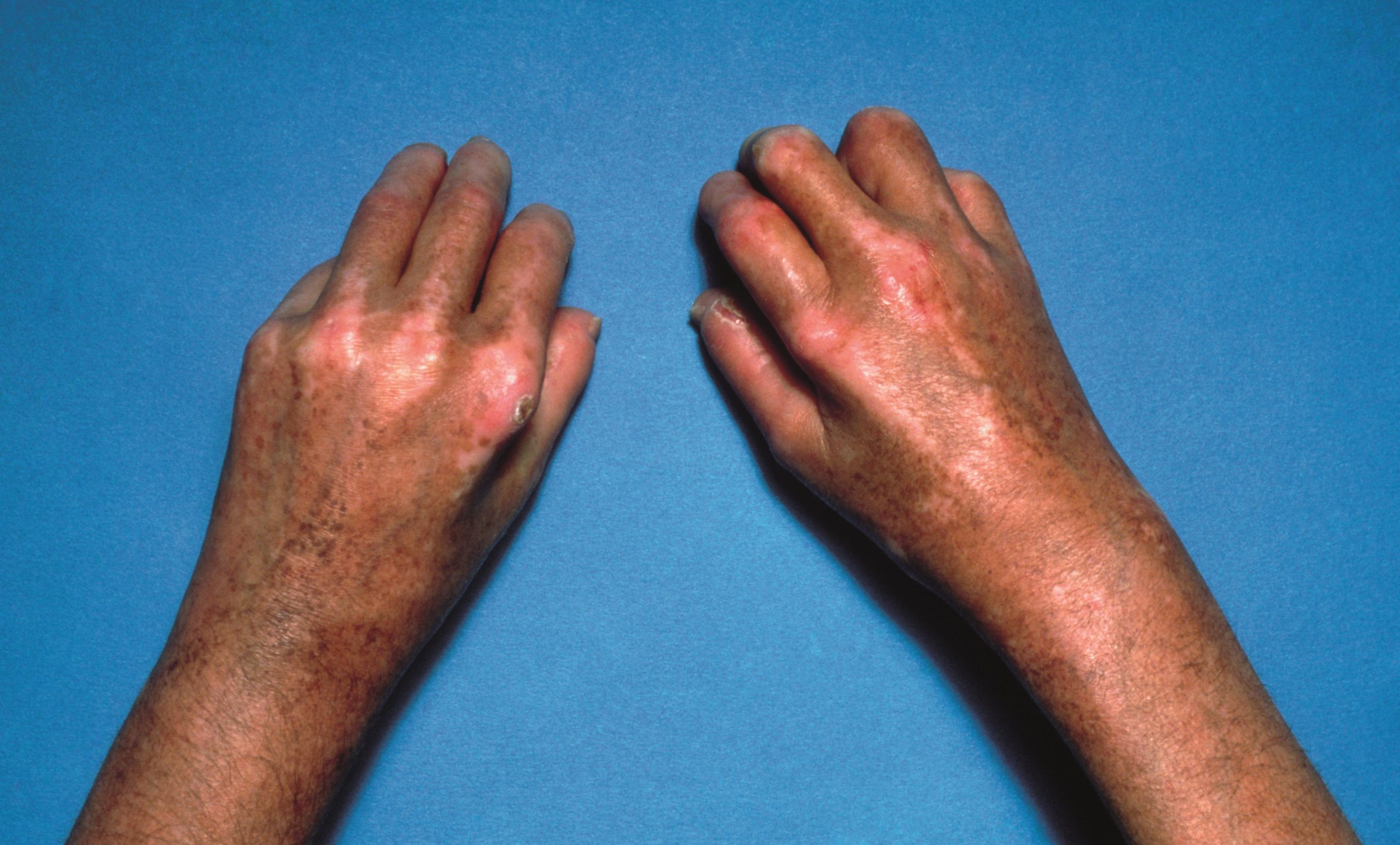 Scleroderma: management - The Pharmaceutical Journal