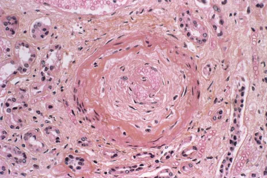 Light micrograph of scleroderma, an autoimmune condition that causes fibrosis of the skin and connective tissues causing mortality due to multiple complications including pulmonary hypertension and renal crisis
