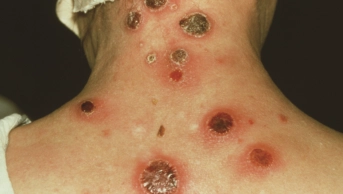 Secondary syphilis rash at the nape of patient's neck