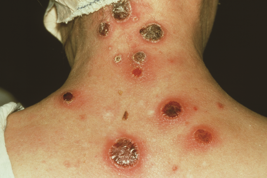 Secondary syphilis rash at the nape of patient's neck