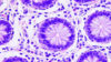 Colon cancer cells under a microscope