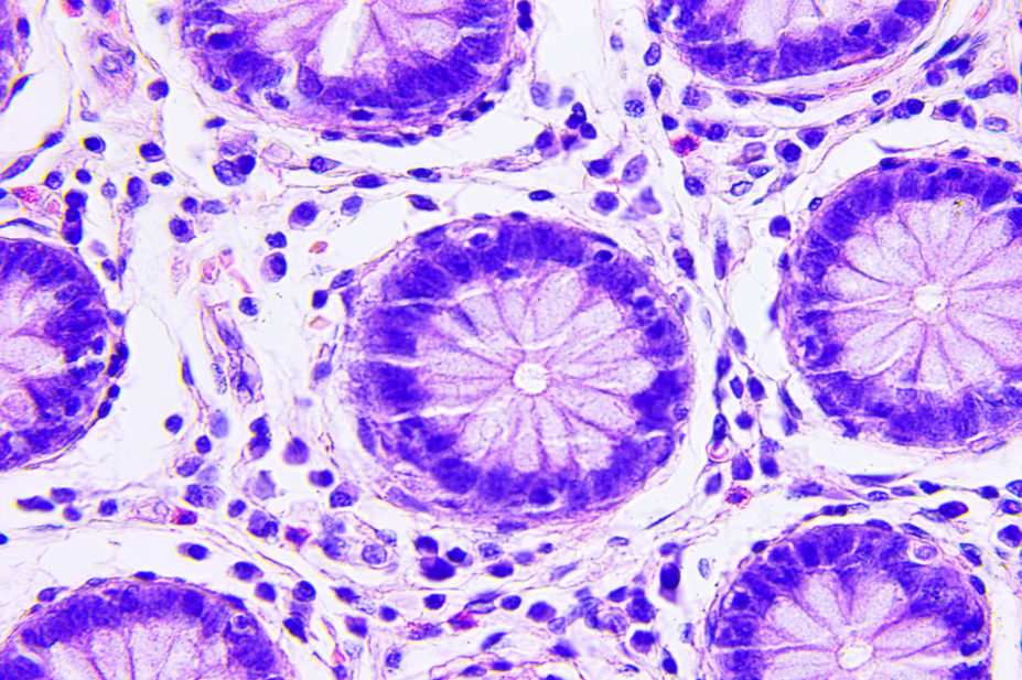 Colon cancer cells under a microscope