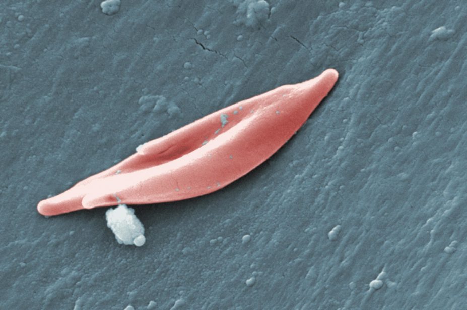 Sickle cell disease is the most common inherited blood disorder in the UK, affecting 12,000–15,000 people. Although it is a life-shortening condition, its symptoms and complications can be effectively managed. Pictured, SEM of a sickle cell red blood cell