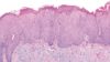 nsaids skin biopsy solar elastosis actinic keratosis 14
