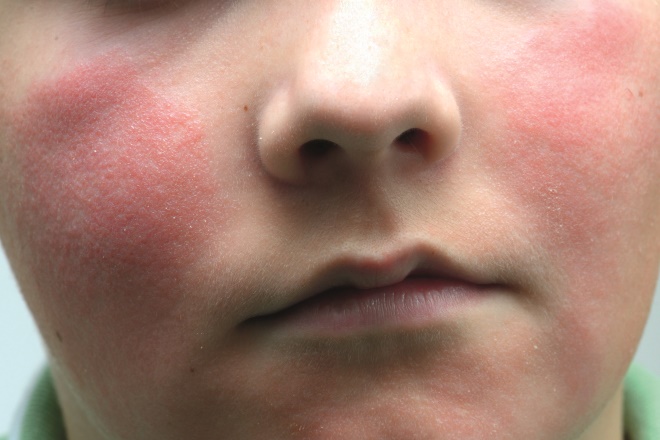 Rashes & spots (pictures) in toddlers, children & babies - NHS