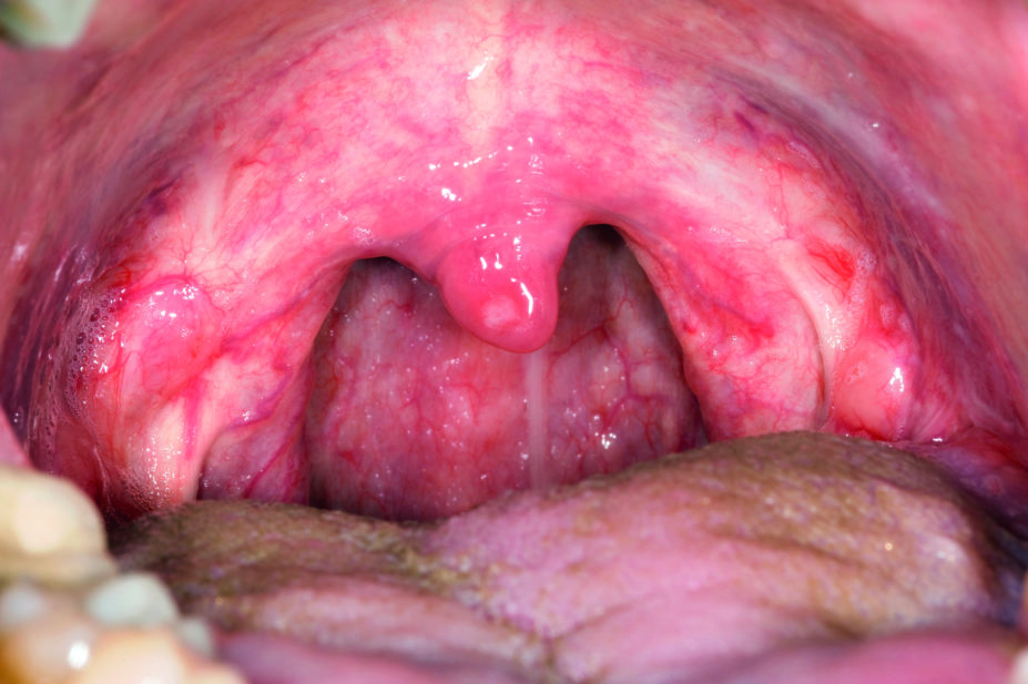 Close up of sore throat or acute pharyngitis