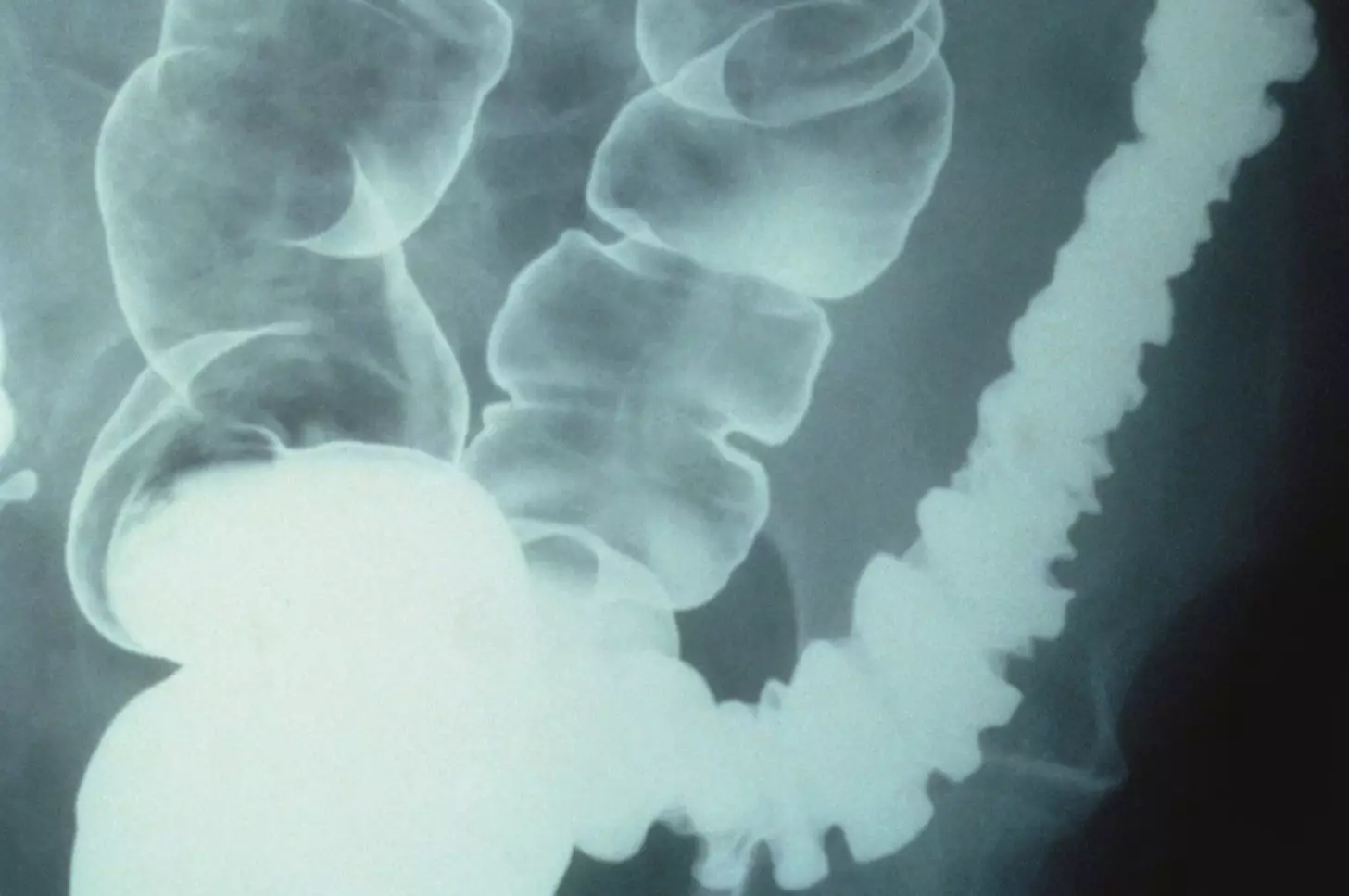 FDA approves two new drugs for irritable bowel syndrome The