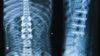 x-ray-of-spine