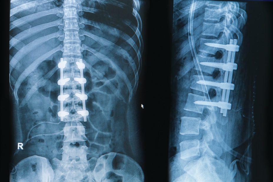 x-ray-of-spine