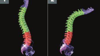 Image 1 shows a normal spine and image 2 shows a spine affected by spondylitis