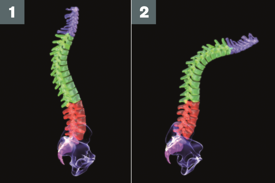 Image 1 shows a normal spine and image 2 shows a spine affected by spondylitis