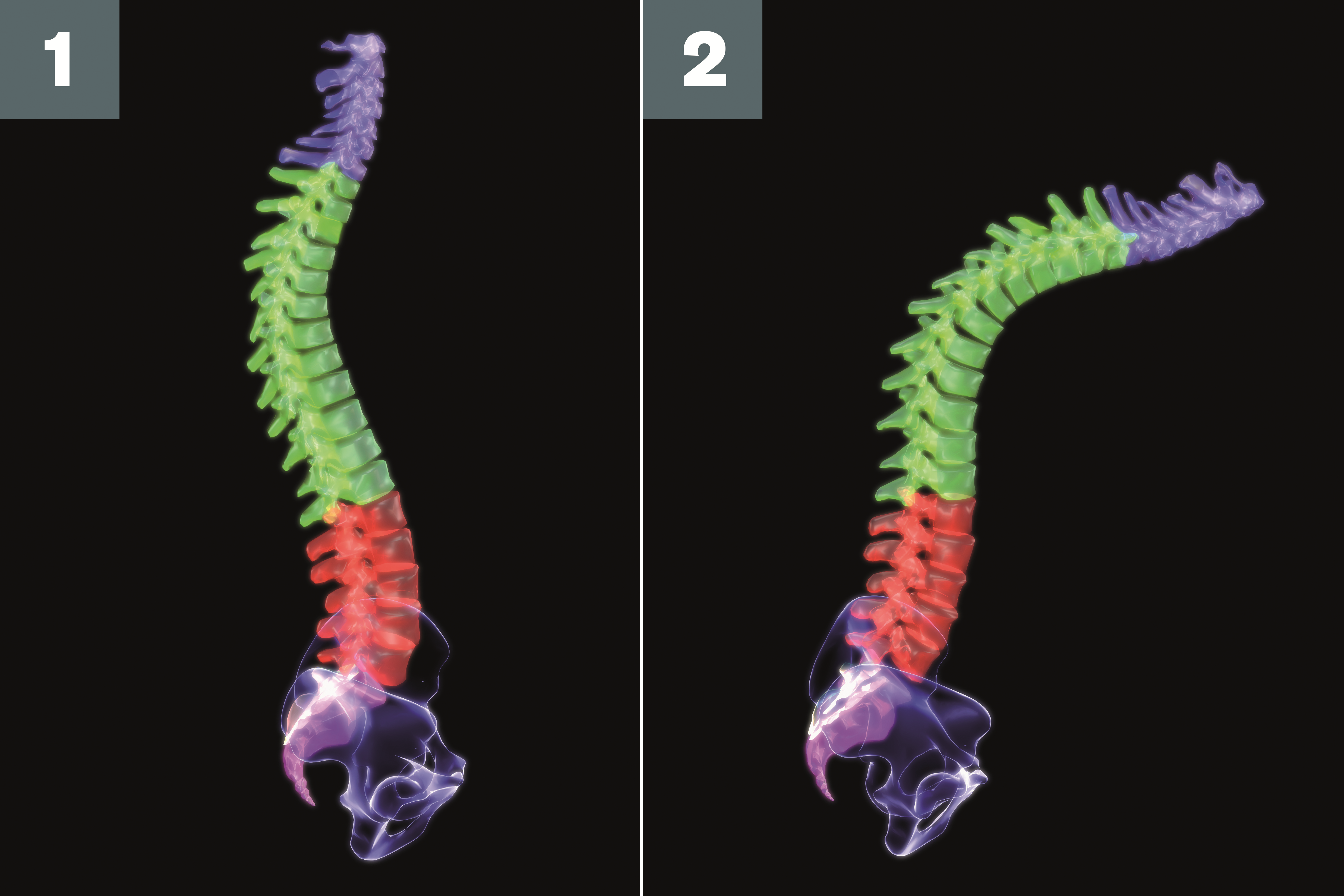 SMC Arthritis Forum/Dr.Hanady Manasfi on X: Comparison #BASDAI and #ASDAS  #spondyloarthtopathy #EULAR2020  / X