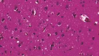 Victims of Creutzfeldt–Jakob disease (CJD) show evidence of Alzheimer’s pathology, suggests new research. In the image, micrograph of a brain with CJD