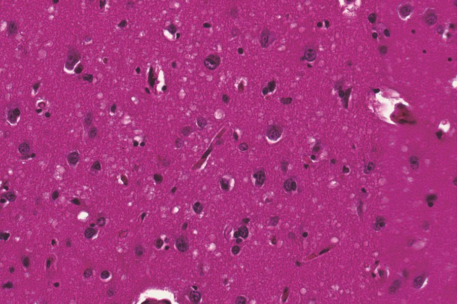 Victims of Creutzfeldt–Jakob disease (CJD) show evidence of Alzheimer’s pathology, suggests new research. In the image, micrograph of a brain with CJD