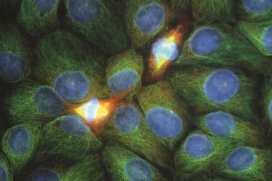 Cellular protein focal adhesion kinase (FAK), may help shield tumours from the immune system, by inhibiting FAK researchers were able to shrink tumours in mice. In the image, light micrograph of squamous carcinoma cells