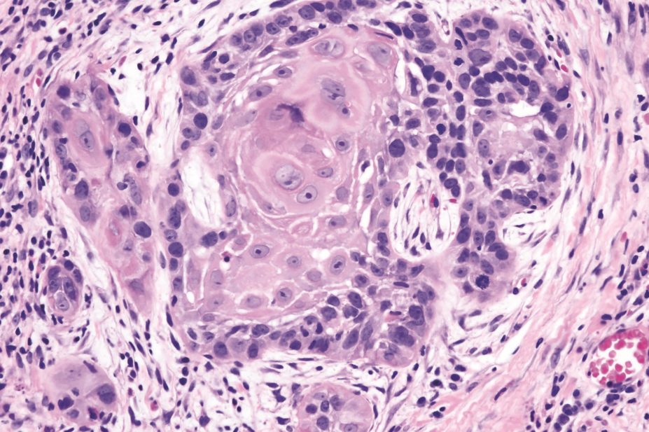 Histopathology stain of squamous-cell carcinoma