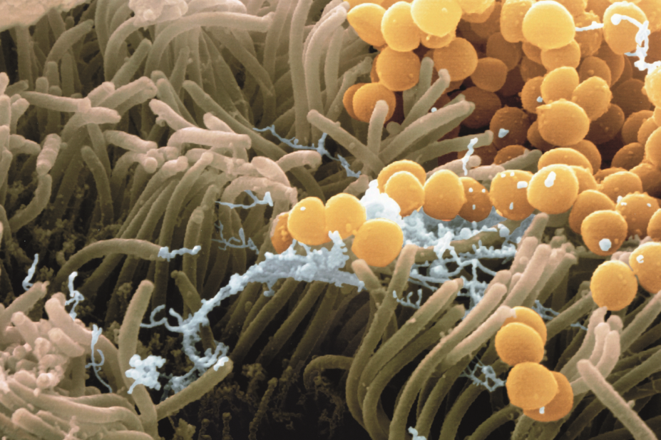 Micrograph of Staphylococcus aureus bacteria (yellow) on human nasal epithelial cells
