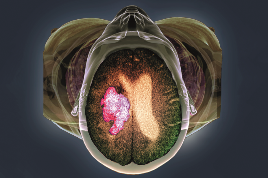 3D CT scan of a person with a stroke