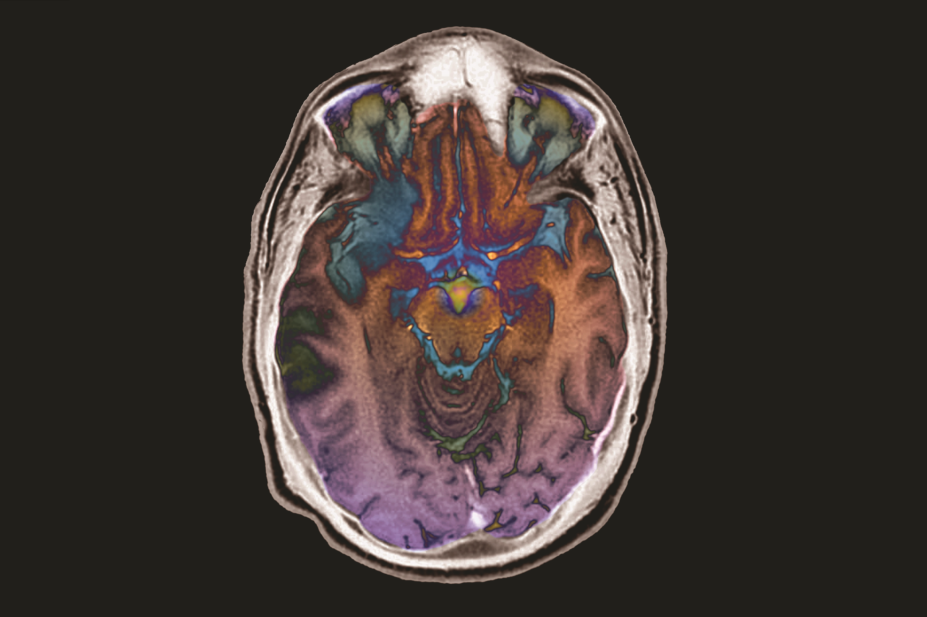 Brain scan of a stroke patient