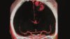 Ciclosporin fails to demonstrate protection from neuronal damage during thrombolysis, new study finds. In the image, an MRI scan on a patient with ischaemic stroke