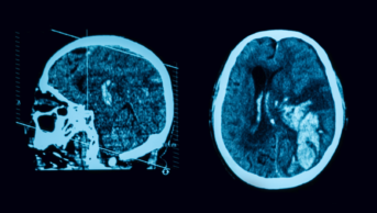 CT scan of brain following a stroke