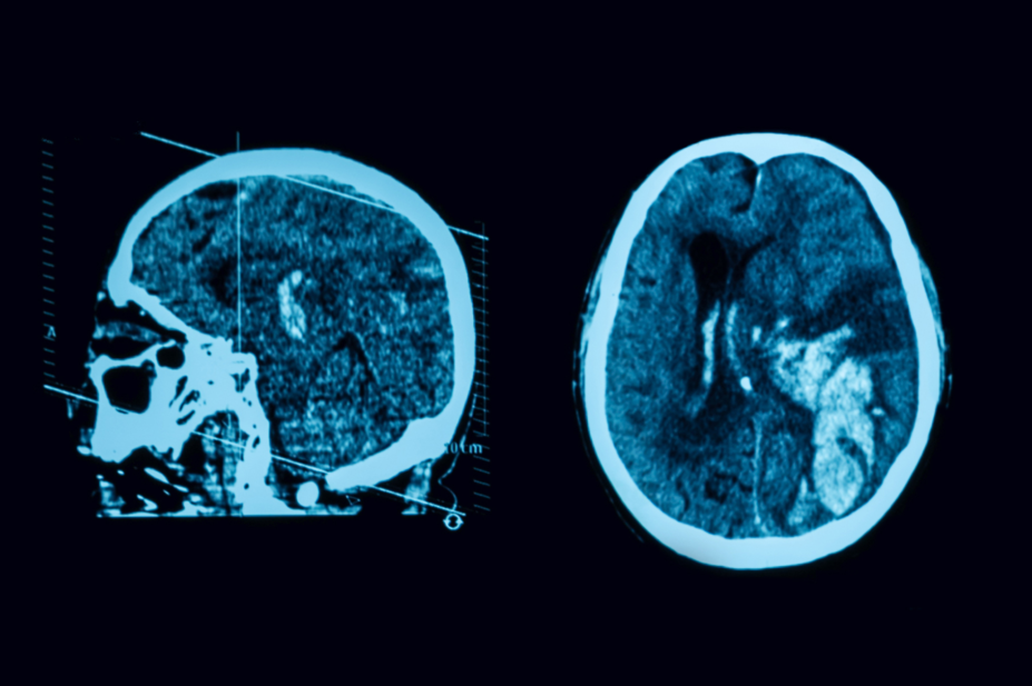 CT scan of brain following a stroke