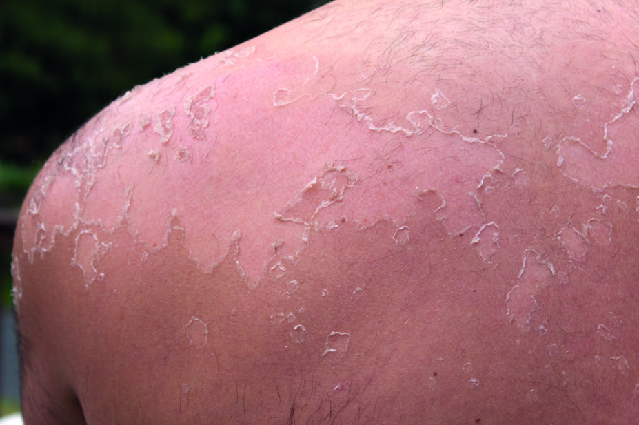 Close up of sunburned, peeling skin