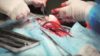 Close up of organ transplant surgery