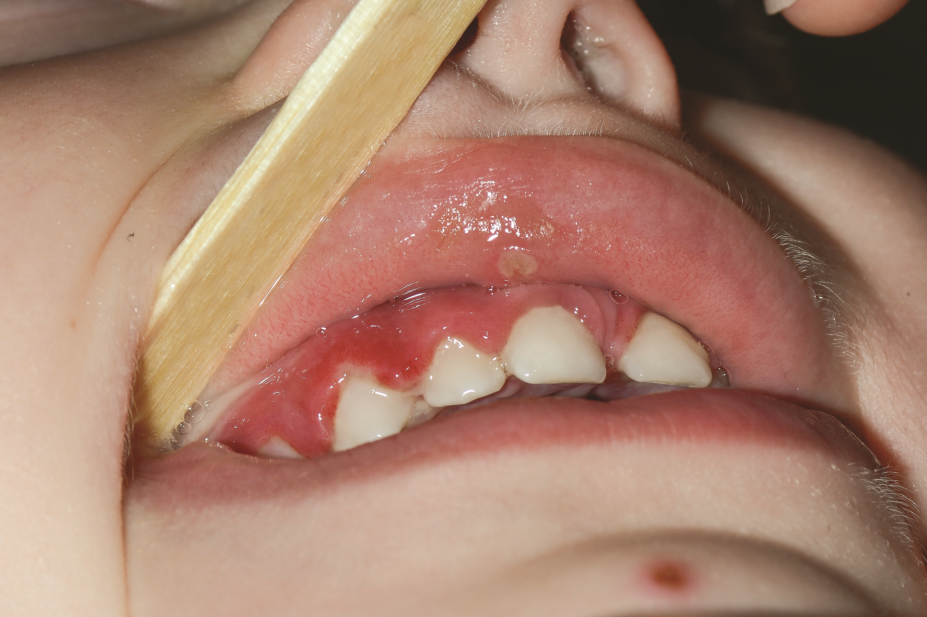 patient with swollen gum