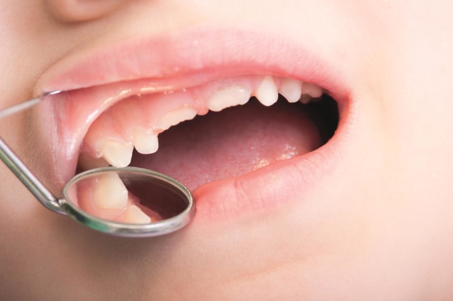 Local anaesthetics routinely given to children undergoing dental treatment may affect tooth cell growth and development, according to research. In the image, a young child has a dental appointment