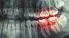 Teeth x-ray, dental pain concept