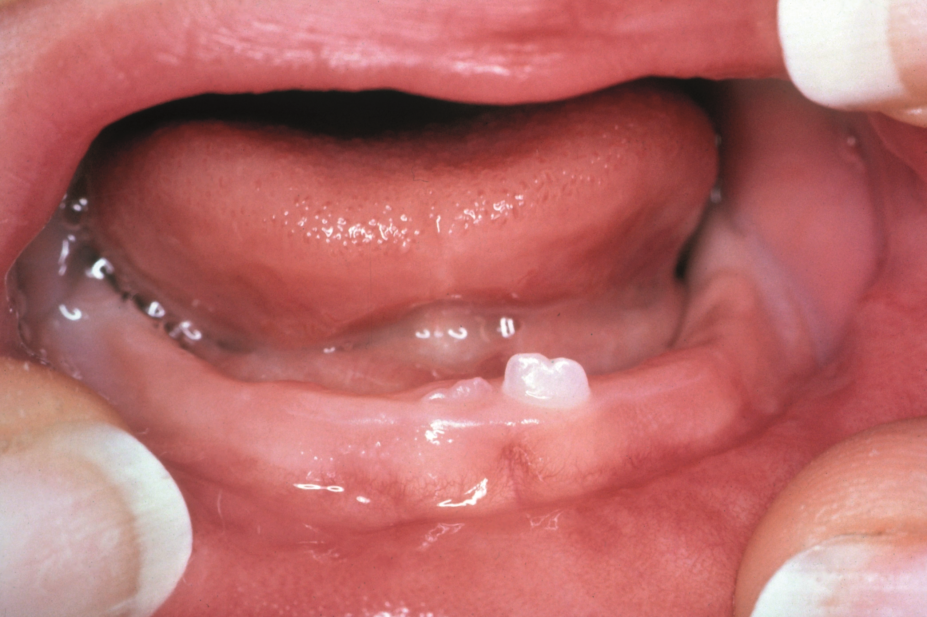 Teething, close up of a 6-month old baby's mouth